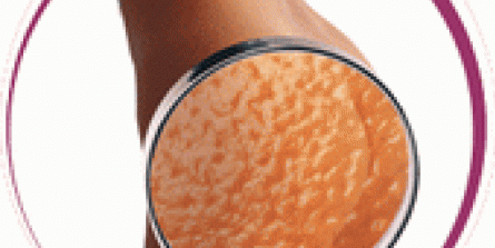 Cellulite pakkinn
